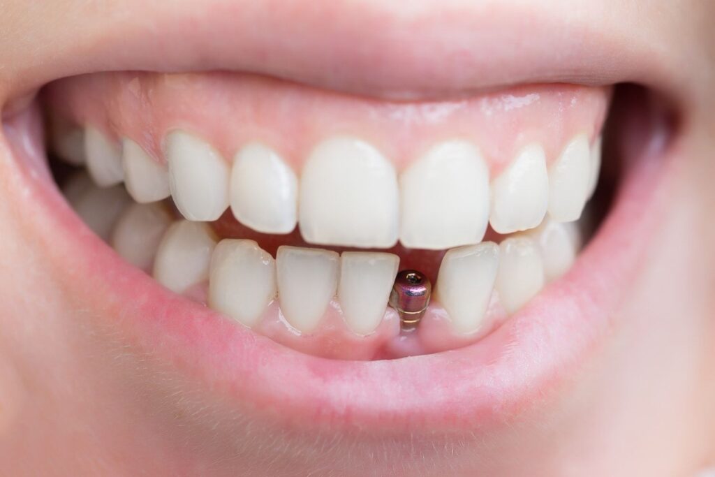  ایمپلنت دندان بدون جراحی