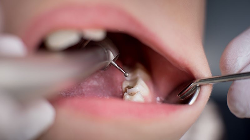  فلوراید تراپی با دندانپزشک