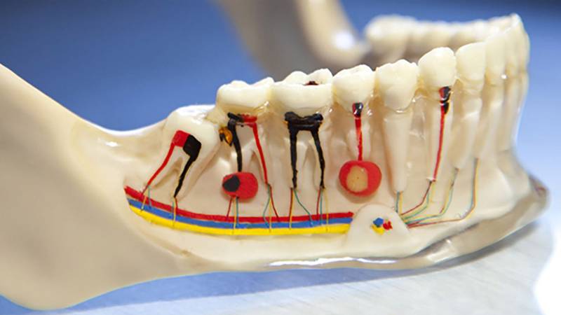 تشکیل کیست دندان