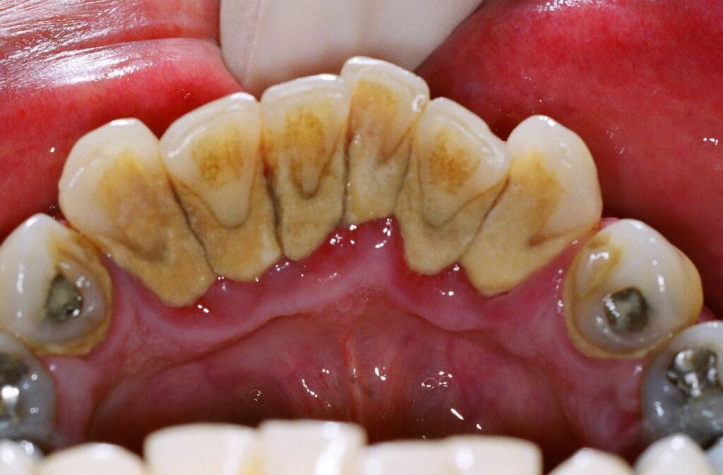 جرم‌گیری دندان چیست؟