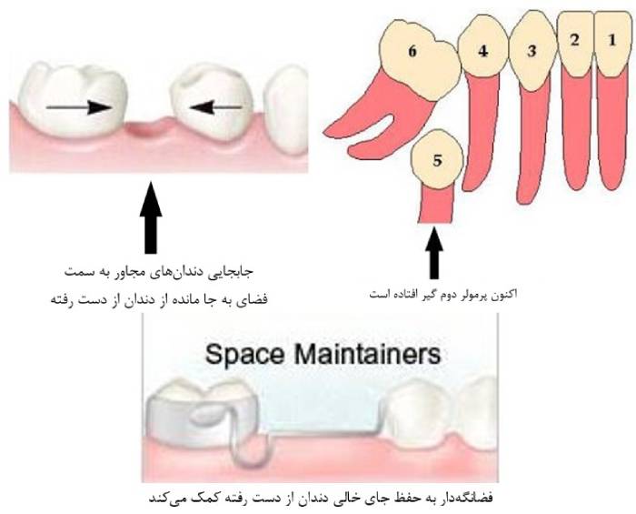 فضا نگهدارنده دندان