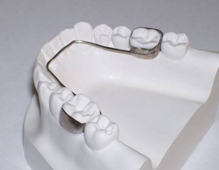 فضا نگهدارنده دندان ثابت
