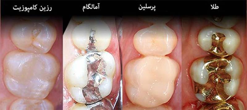انواع ماده پر کردن دندان
