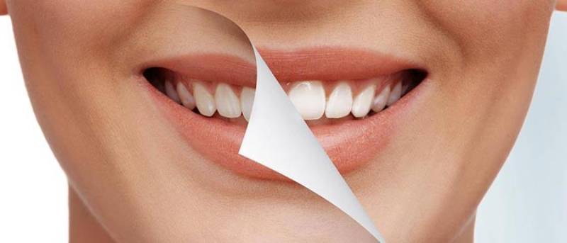 روکش دندان برای درمان فلوئوروزیس