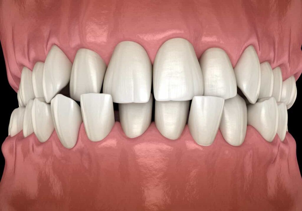 کراس بایت دندان چیست؟