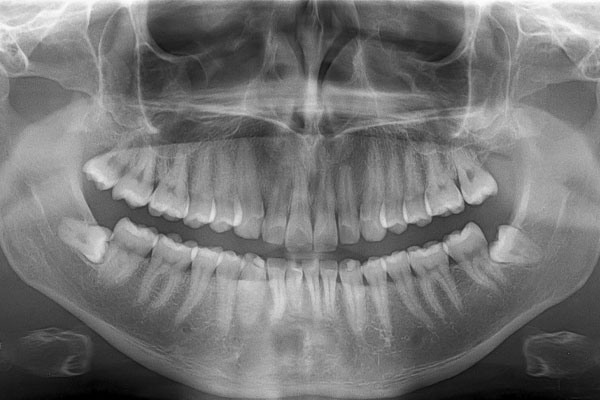 عکس OPG دندان چیست؟