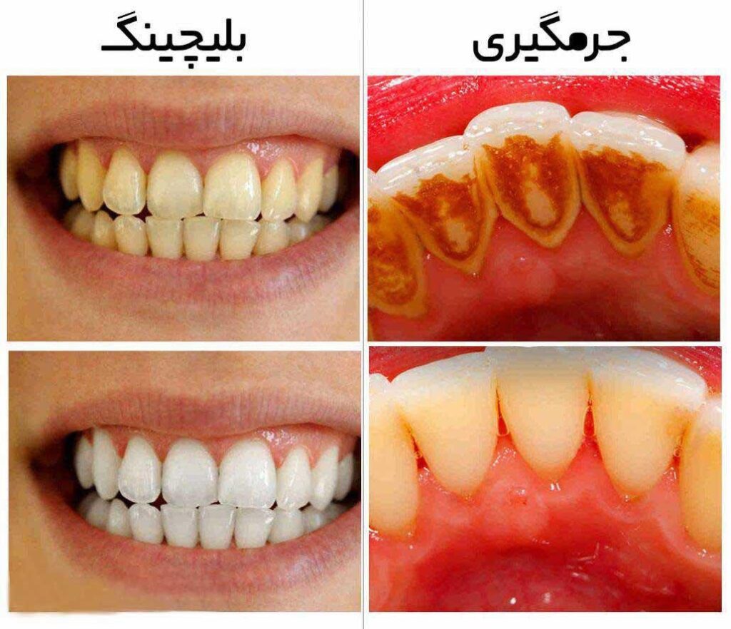 تفاوت بلیچینگ و جرمگیری دندان چیست؟