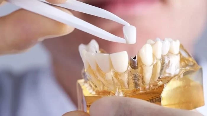  لق شدن ایمپلنت دندان