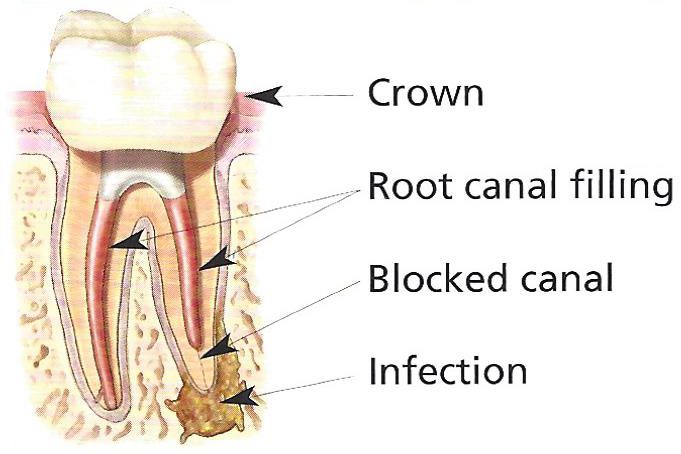 شکستن فایل درون کانال نیاز به عصب کشی مجدد دندان 
