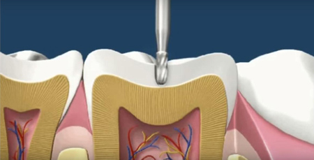 فرایند پر کردن دندان شیری