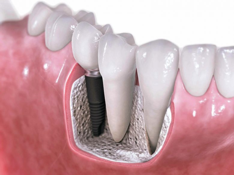 شباهت - ثبات ایمپلنت دندان 