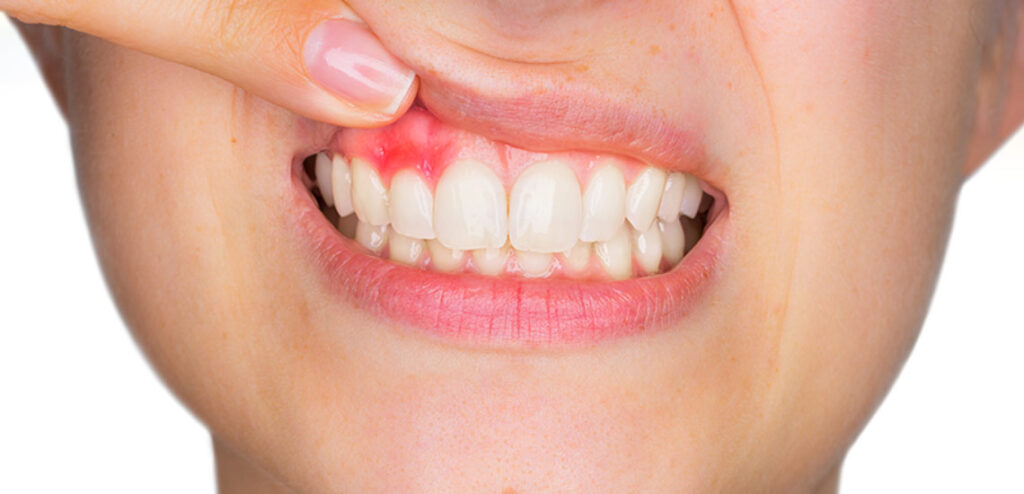علت دندان در  آبسه ی دندان