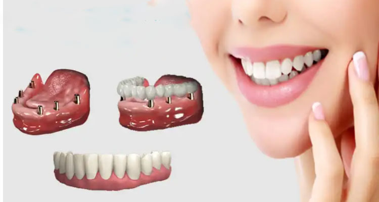 ایمپلنت در ترمیم دندان