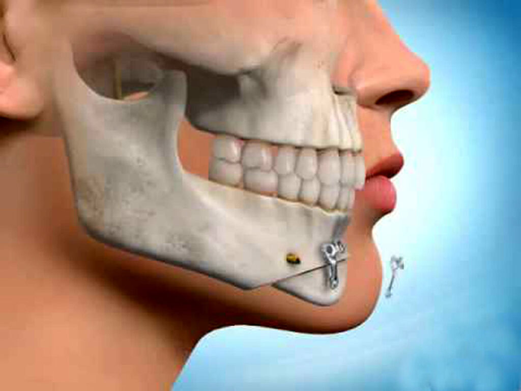 آشنایی با جراحی فک و روند عمل جراحی  + بررسی مزایا و عوارض آن و معرفی انواع جراحی فک 7 جراحی فک