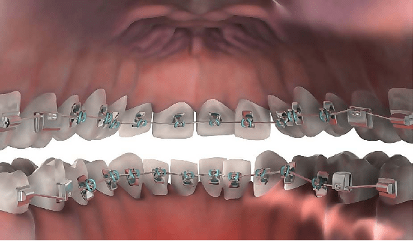 معرفی انواع ارتودنسی لینگوال 
