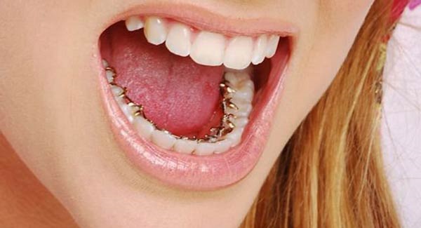 ارتودنسی لینگوال مناسب برای چه افرادی است؟