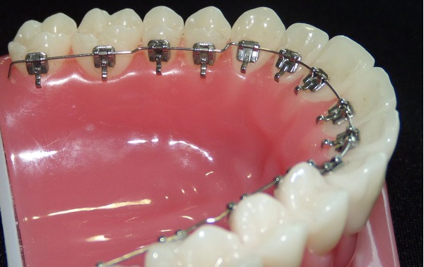 ارتودنسی نامرئی (اینوایزالاین، لینگوال، سرامیکی): مزایا، معایب و هزینه 5 لینگوال