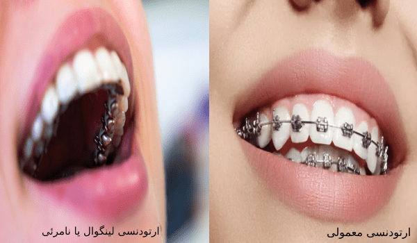 تفاوت ارتودنسی معمولی با لینگوال در چیست؟