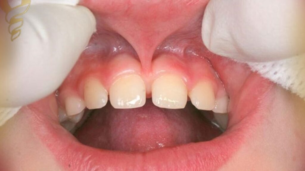 فرنوکتومی چیست؟