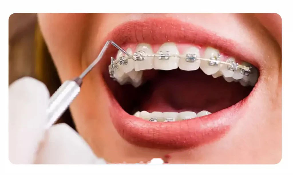 ارتودنسی متحرک بهتراست یا ثابت؟