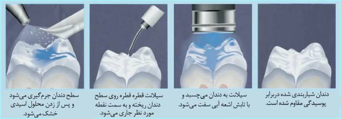مراحل فیشور سیلانت دندان