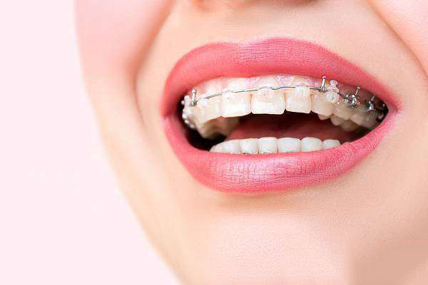 ارتودنسی سریع برای بزرگسالان: روشها، واقعیتهای علمی و هزینه 5 ارتودنسی سریع