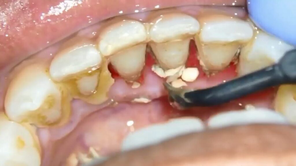 جرم گیری دندان چیست و چرا انجام می‌شود؟