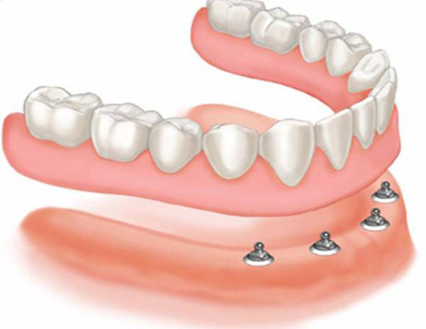 اوردنچر ( over denture )