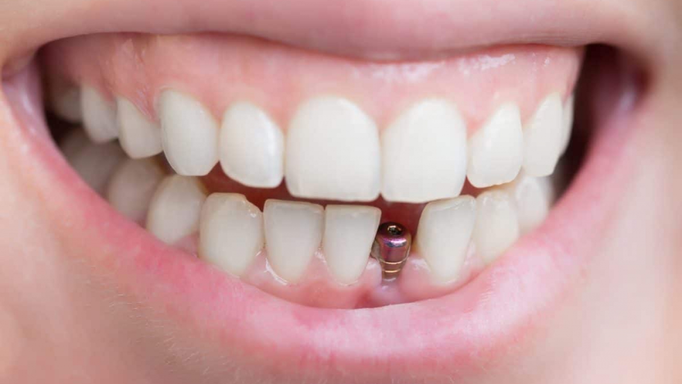 شباهت ایمپلنت و دندان طبیعی