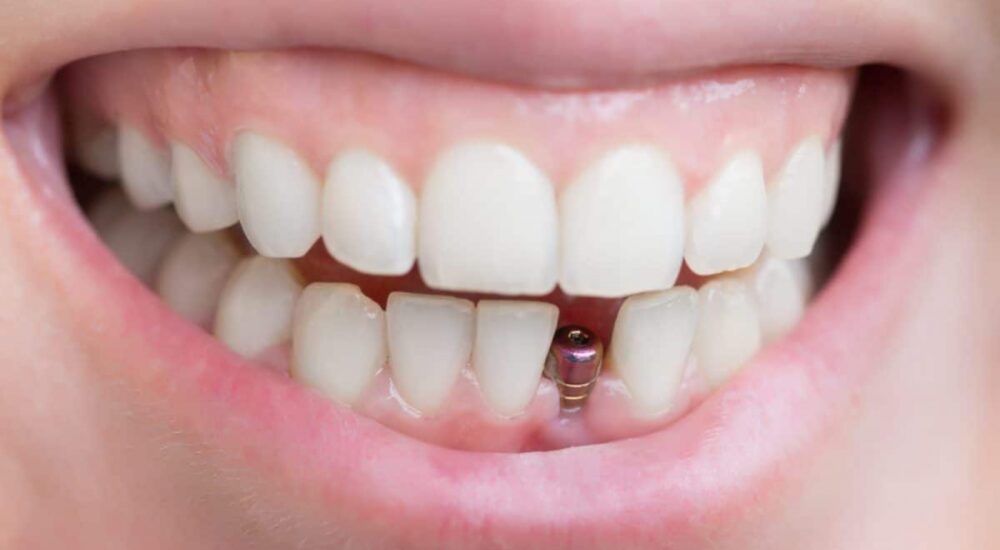 شباهت ایمپلنت و دندان طبیعی