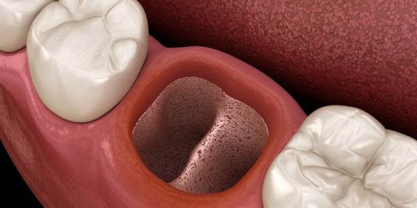 حفره خشک دندان چیست؟ + علائم و نشانه های ایجاد حفره خشک دندان چیست؟ 4 حفره خشک دندان