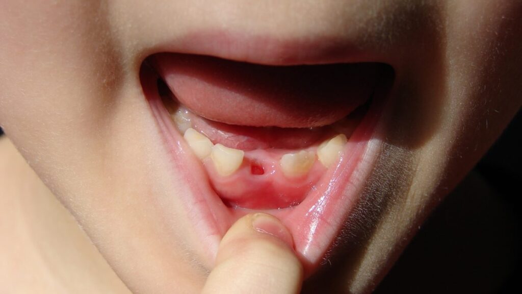 حفره خشک دندان