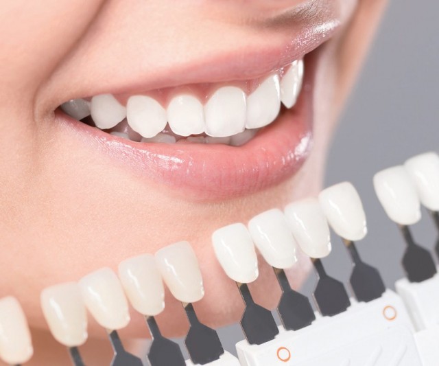 لومینیرز دندان