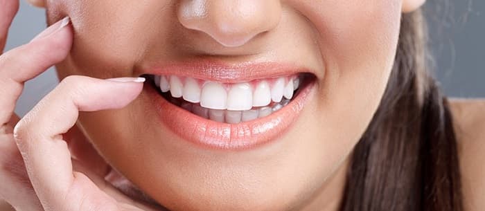 لومینیرز دندان