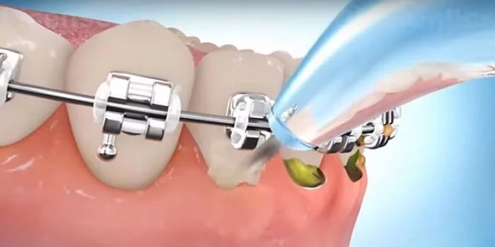  نخ دندان کشیدن