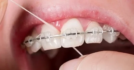  نخ دندان کشیدن