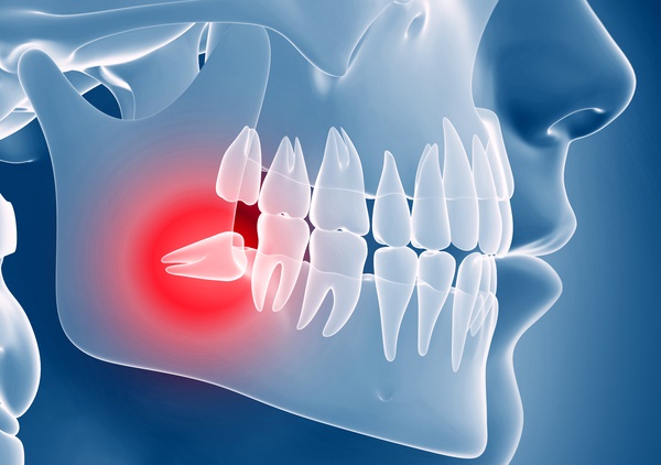 انواع جراحی دندان عقل
