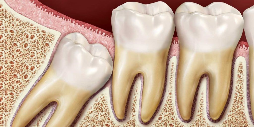 انواع جراحی دندان عقل 