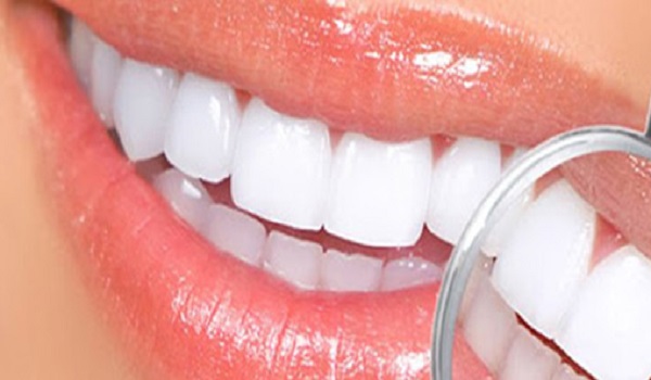 لومینیرز دندان