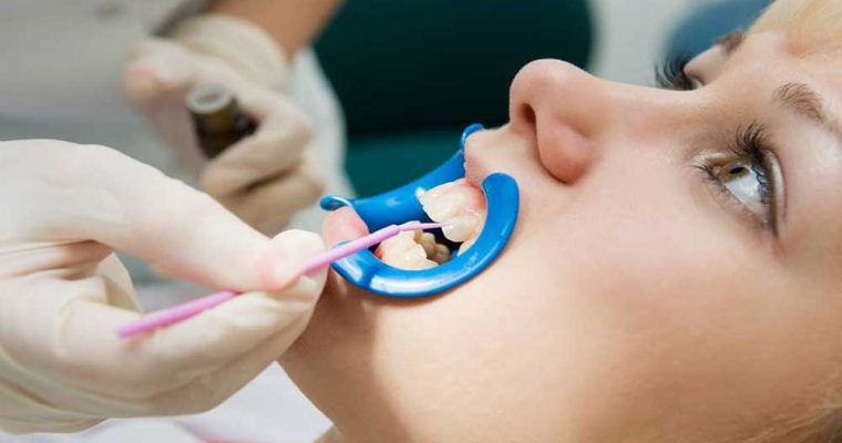 بلیچینگ دندان