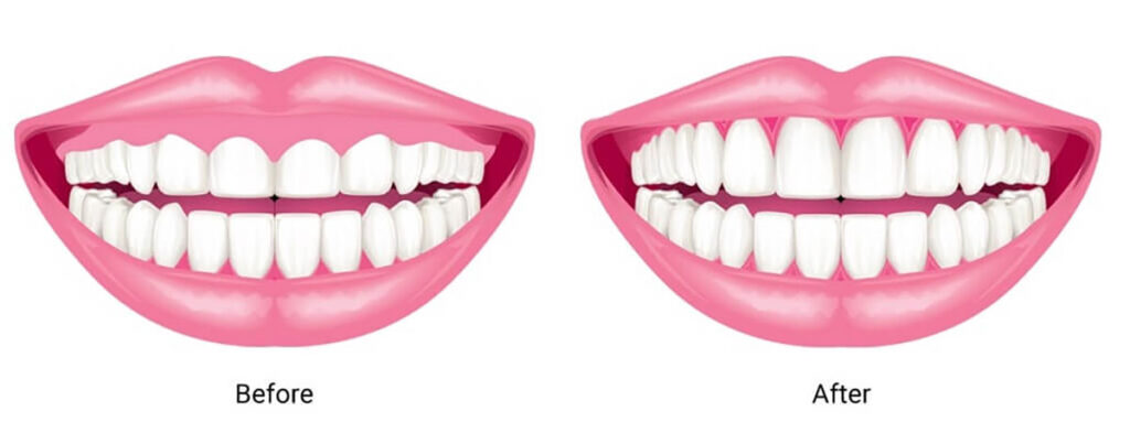 جراحی های کوچک دندانپزشکی: فرنکتومی و افزایش طول تاج دندان 10 افزایش طول تاج دندان