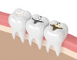 پرکردن دندان