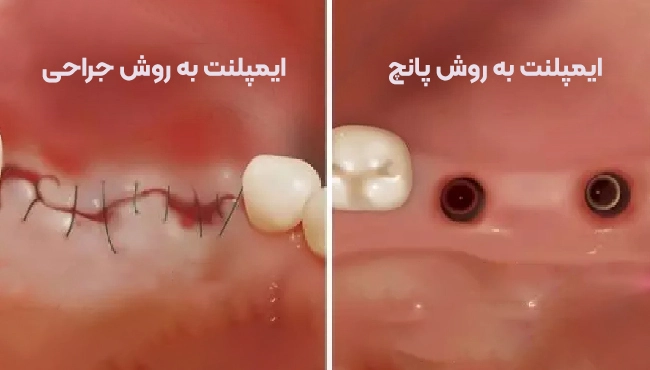 ایمپلنت دندان بدون جراحی