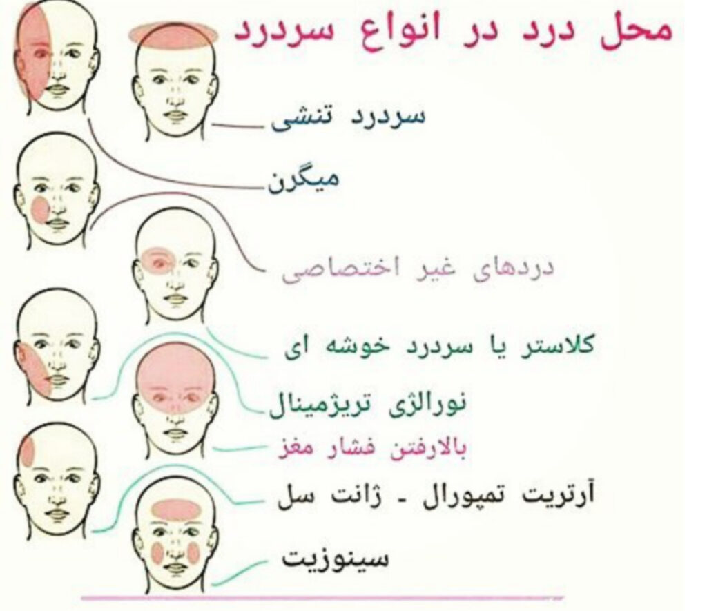 علت سردرد بعد از غذا خوردن