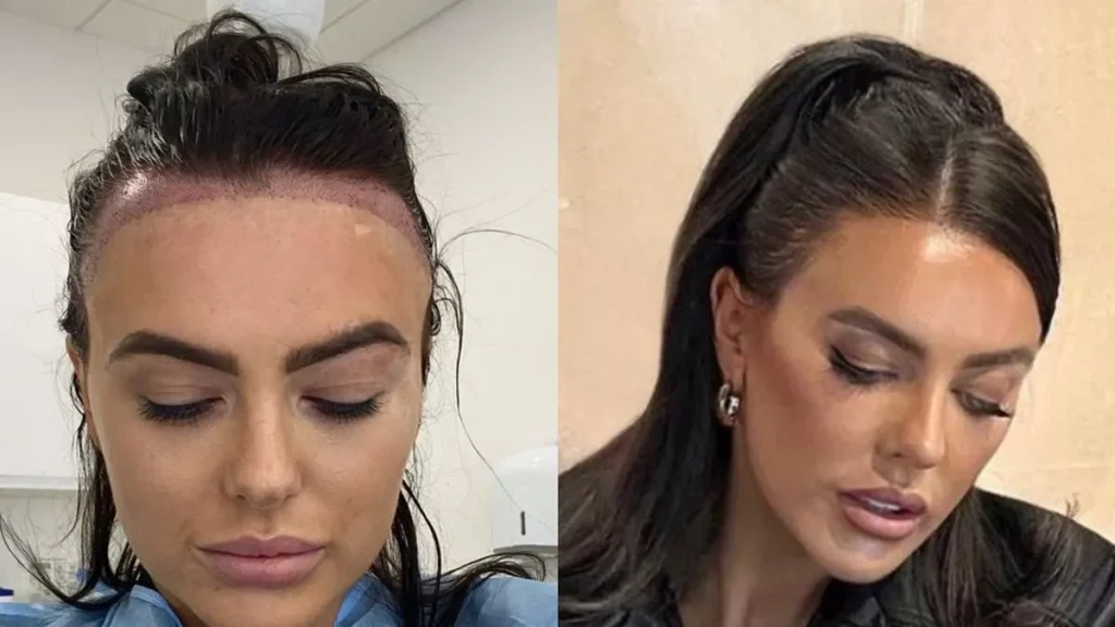 کاشت مو چند ساعت طول میکشد