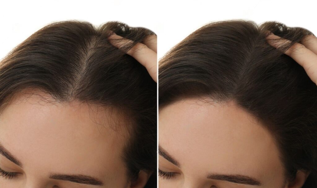 مراحل کاشت مو