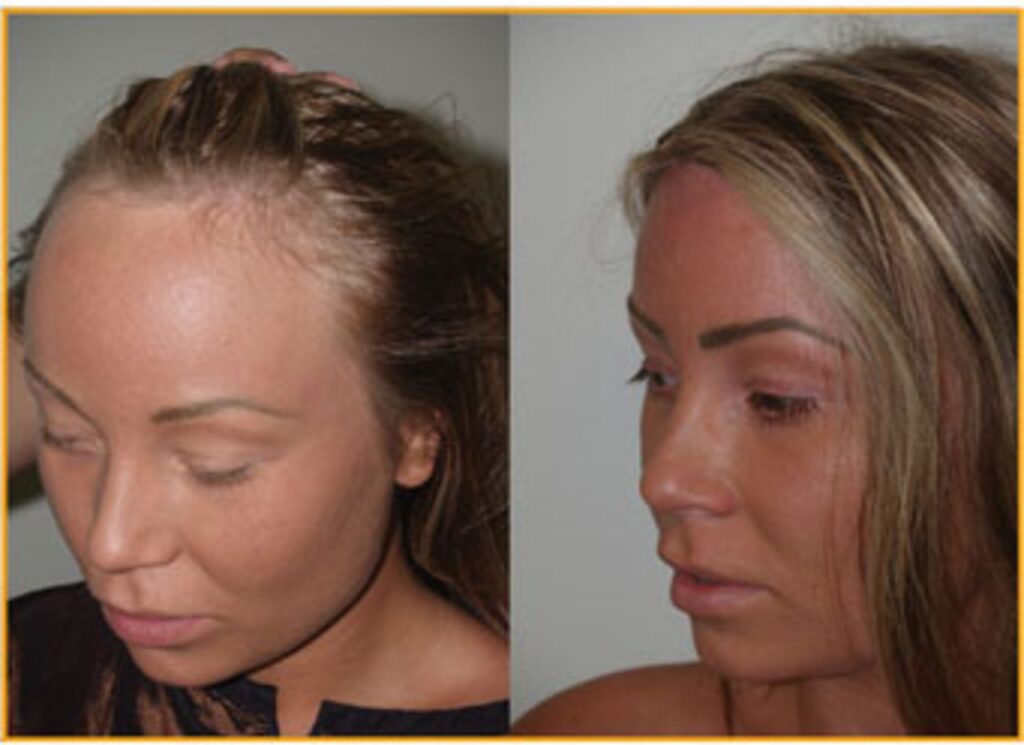 کاشت موی غیر طبیعی