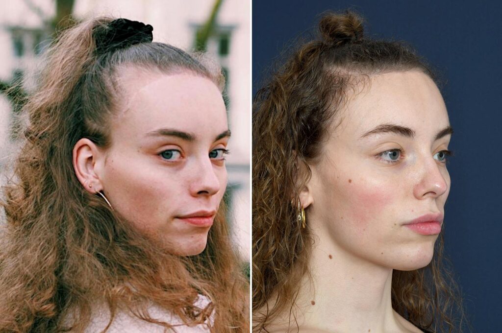 کاشت مو پیشانی زنان 4 Forehead hair transplant for women