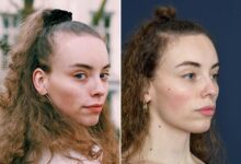 Forehead hair transplant for women