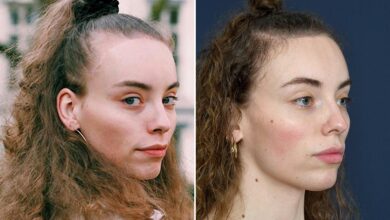 Forehead hair transplant for women